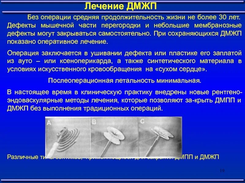 Эндоваскулярные методы лечение ДМЖП. Подаортальный дефект межжелудочковой перегородки. Дефект межпредсердной перегородки операция. Транскатетерное закрытие дефекта межжелудочковой перегородки.