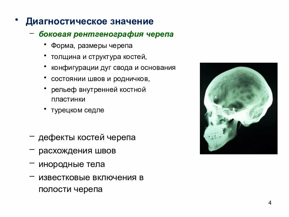 Строение костей свода черепа. Внутренняя костная пластинка черепа. Внутренняя пластинка свода черепа. Послойная топография свода черепа. Лицевой череп рентгеноанатомия.