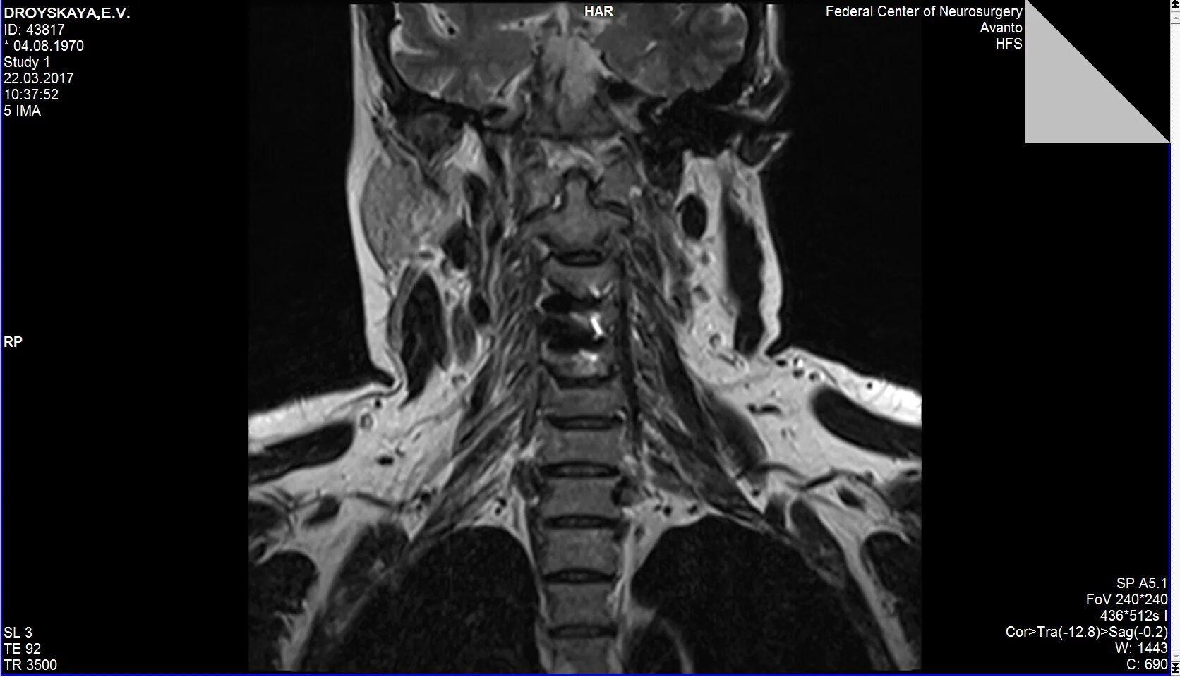 Шейный отдел позвоночника нестабильность с7. Нестабильность с1. Подвывих с5 позвонка. Шейный отдел позвоночника рентген с1-с2. Нестабильность шейного отдела позвоночника рентген.