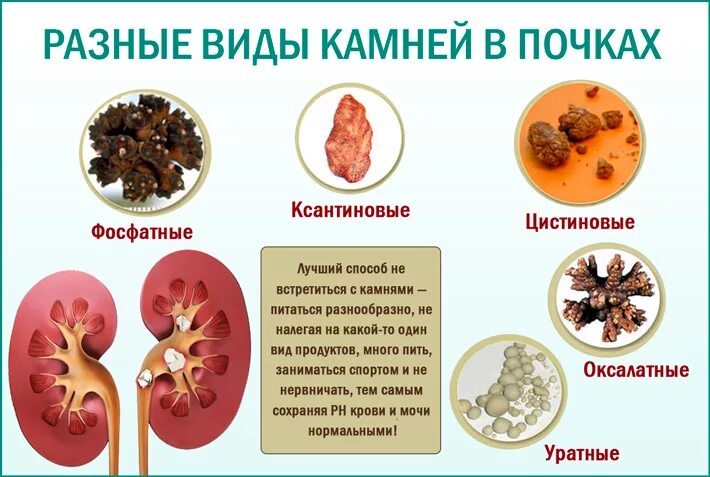 Классификация камней при мочекаменной болезни. Конкременты при мочекаменной болезни. Мочекаменная болезнь цистиновые камни. Типы конкрементов при мочекаменной болезни. Какая минеральная вода камни в почках