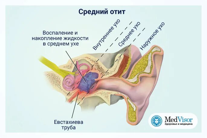 Воспаление слуховой евстахиевой трубы.