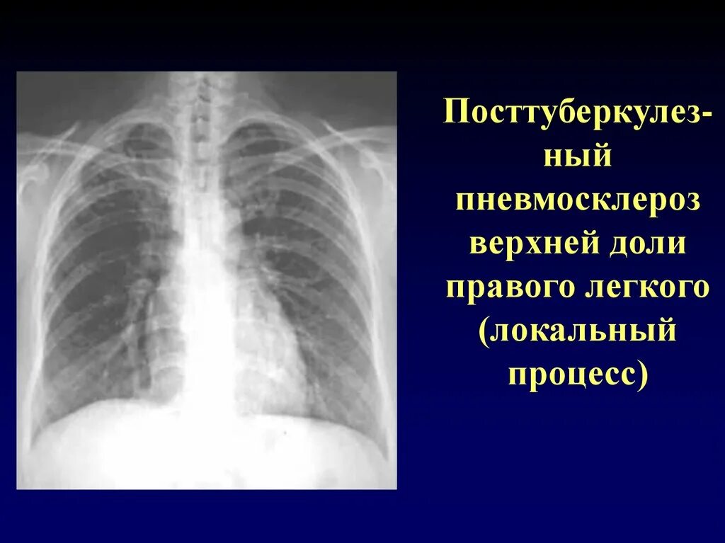 Посттуберкулезный пневмофиброз. Посттуберкулезный пневмосклероз. Узелковый пневмосклероз. Пневмосклероз это простыми словами