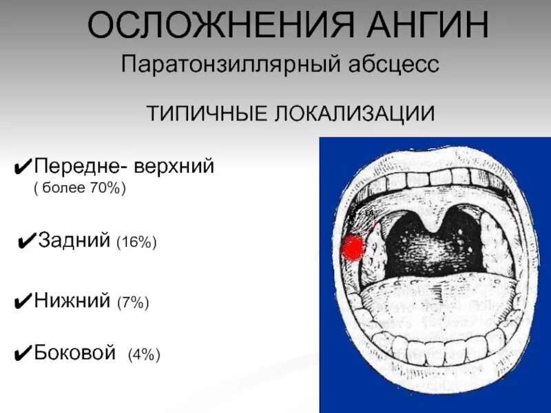 При передневерхней локализации абсцесс формируется. Паратонзиллярный абсцесс. вскрытие паратонзиллярного абсцесса. перитонзиллярный абсцесс. паратонзиллярный абсцесс локализация.