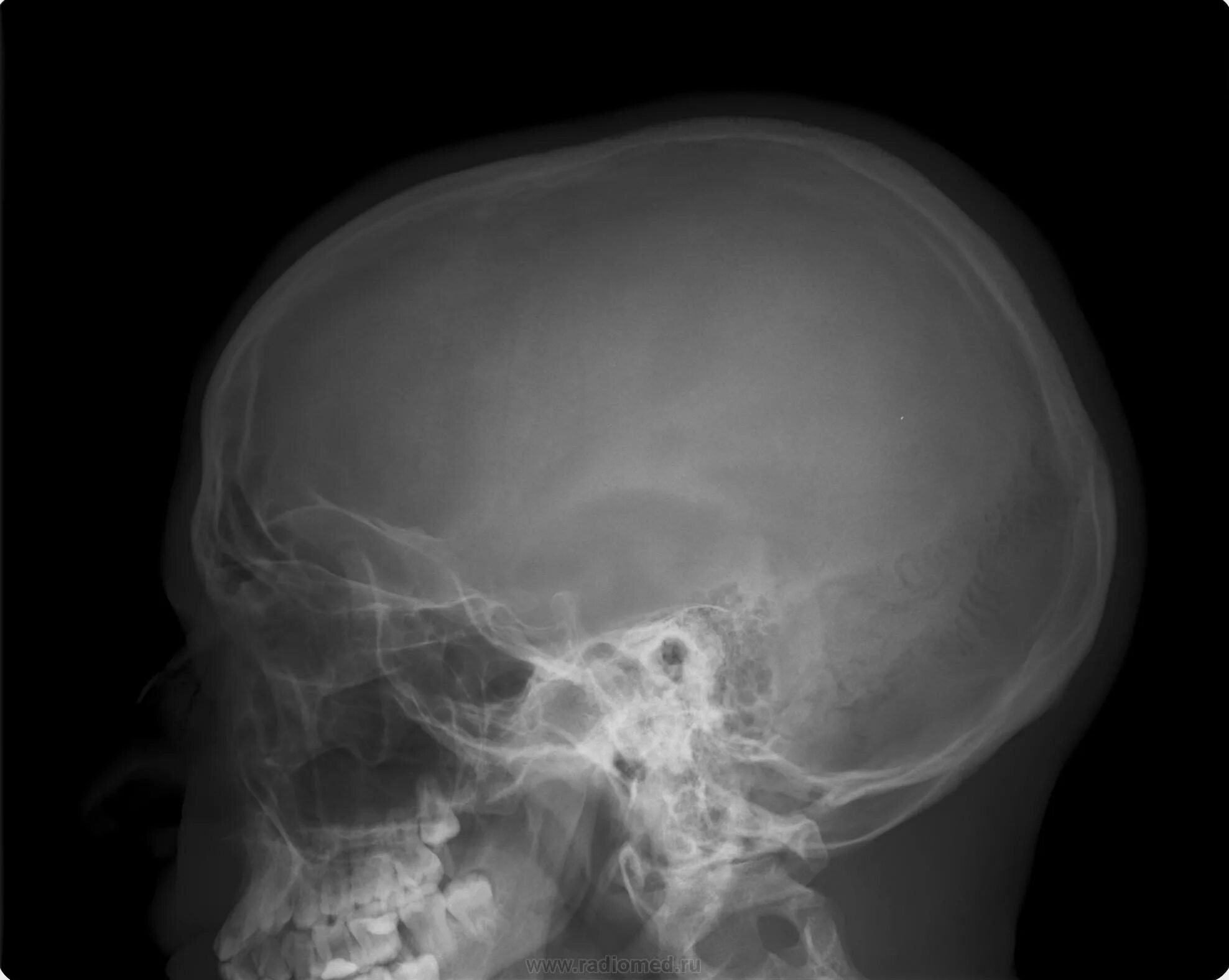 Кости черепа рентген. Перелом височной кости рентген. Перелом костей черепа рентген. Рентген черепа сотрясение мозга. Височная кость черепа рентген.