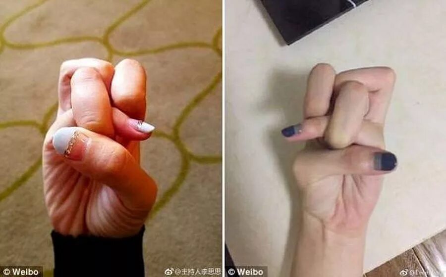 Циркумцизио (обрезание крайней плоти) (схема 2). Псевдогигант сталкер тень чернобыля. Просто будь счастлив. Цитаты иисуса христа из библии. Вплоть до третьего поколения гойя.