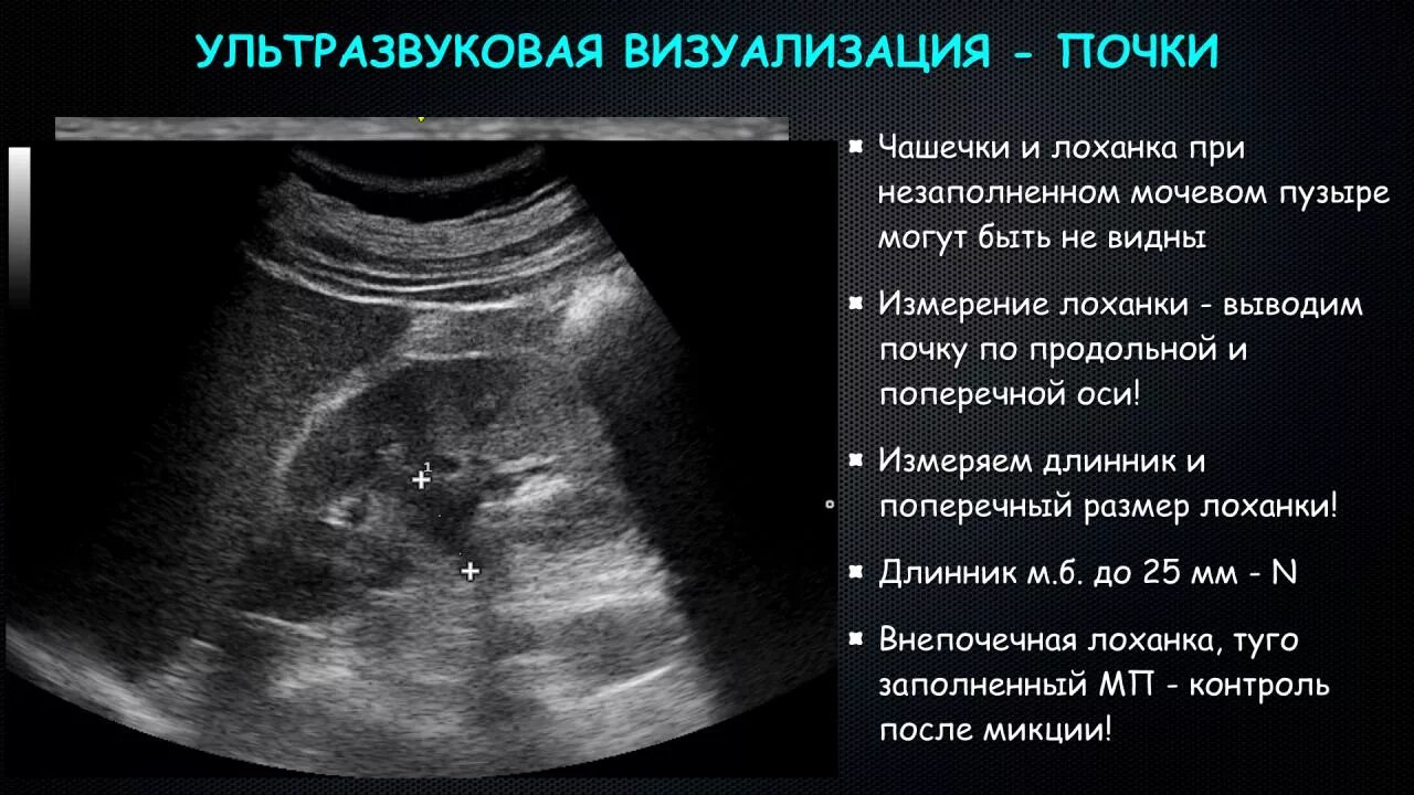 Будет расширена тем самым. Внепочечная лоханка на УЗИ. Расширение лоханки почки на УЗИ. Расширение чашечек почки на УЗИ. Чашечки почки на УЗИ.