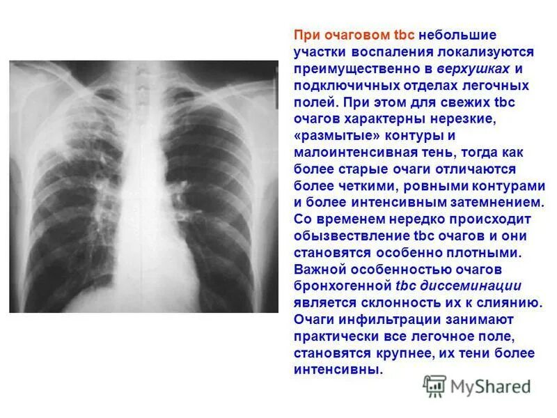 Очаговых изменений правого легкого. Очаговая тень в легочном поле. Форма легочных полей. Мелкие очаговые тени в легких. Очаговое образование легкого.