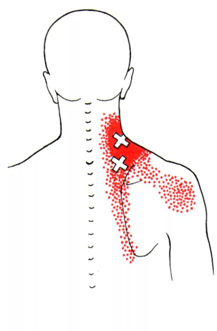 Мышца поднимающая лопатку триггерные точки. Триггерные точки плеча. Триггерные точки мышц шеи. Трапециевидная мышца спины триггерные точки.