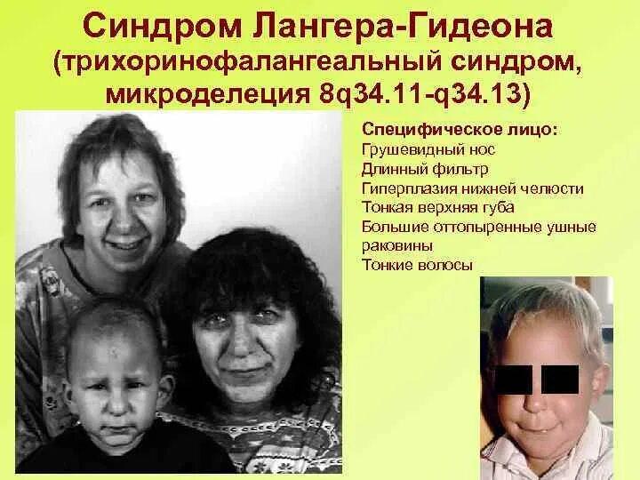 Микроделеция. Микроделеционные синдромы. трихоринофалангеальный синдром. синдром лангера-гидеона. микроделеция хромосомы.
