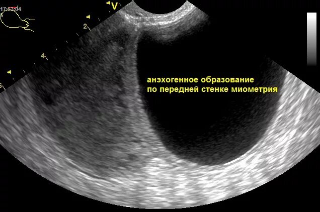 Образование округлое в яичнике. Анэхогенная структура УЗИ. Анэхогенное образование на УЗИ. Анэхогенные включения.