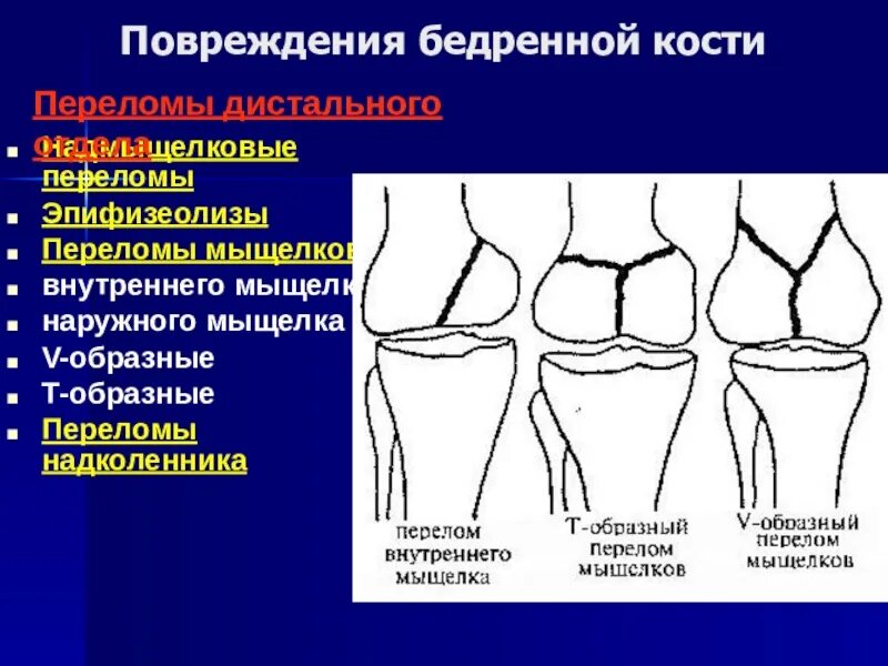 Повреждения мыщелка бедренной кости