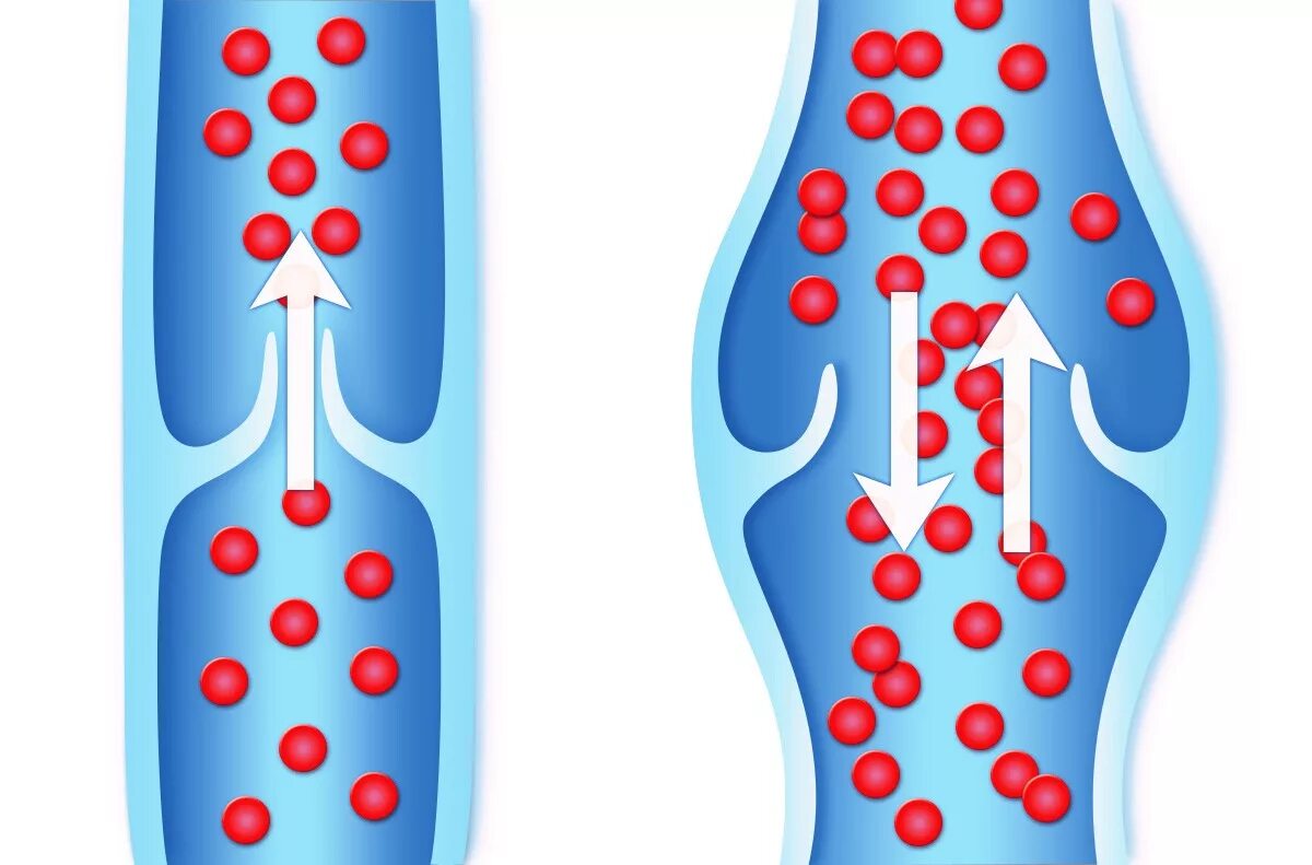 Рефлюкс по венам. Рефлюкс вен нижних конечностей. Варикозное расширение вен нижних конечностей. Варикозное расширение вен пищевода. Эзофагит рефлюкс кислотный.
