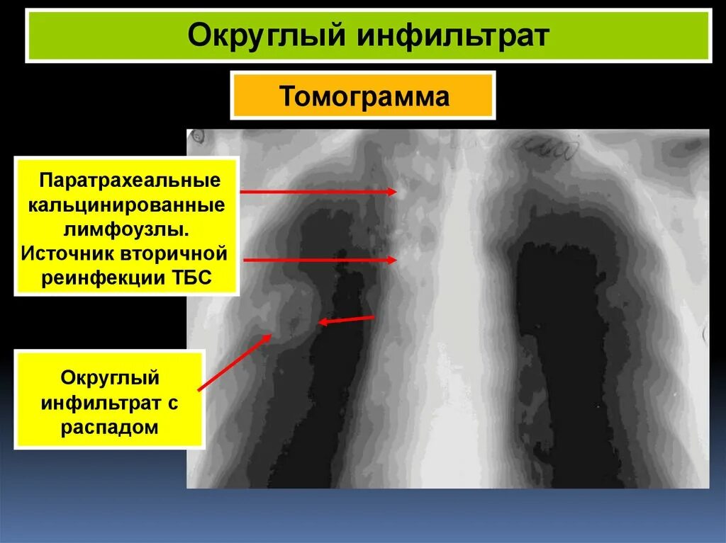 Округлый инфильтрат