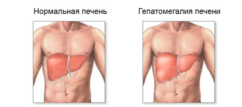 Гепатоспленомегалия селезенки. Увеличенная печень и селезенка.