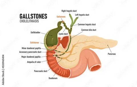 Cholelithiasis латынь