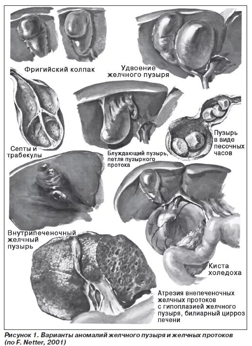 Варианты желчного пузыря