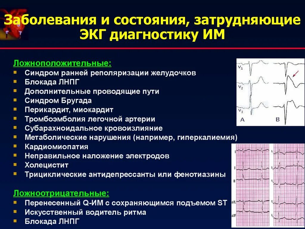 Экг метаболические изменения что это значит. Синдром ранней реполяризации желудочков ЭКГ критерии. Синдром ранней реполяризации ЭКГ критерии. Ранняя реполяризация желудочков по ЭКГ. ЭКГ при синдроме ранней реполяризации.