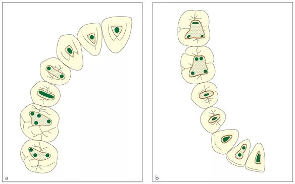 Топография устьев корневых каналов. Топография устьев корневых каналов 36 зуба. Топография корневых каналов 26 зуба. Анатомия устьев корневых каналов зубов.