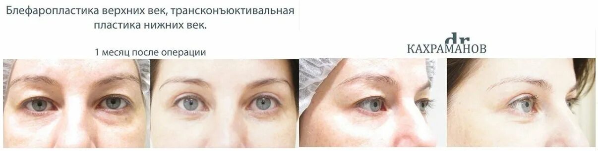 Мазь от синяков после блефаропластики