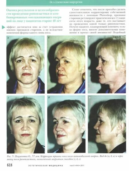 отари гогиберидзе ринопластика. пластическая хирургия владивосток. пластическая хирургия владивосток. хирург приходько. пластическая хирургия владивосток.