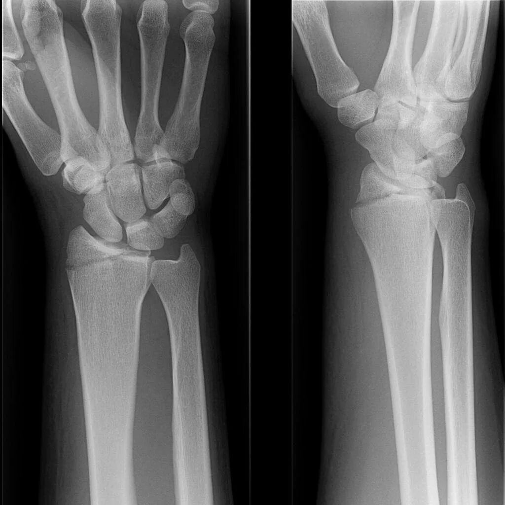 За какое время срастаются кости. Периостит пальца кисти рентген. Перелом эпифиза лучевой кости. Сросшийся перелом кости руки. Срастание кости после перелома.