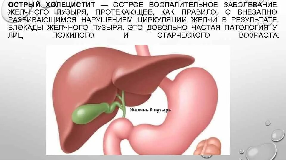 Заболевания органов пищеварения холецистит. Острый воспалительный процесс желчного пузыря. Желчь при остром холецистите. Острый холецистит уход. Острый холецистит тесты с ответами