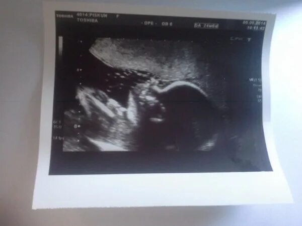 Узи ребенка на 22 неделе беременности. Девочка 22 недели. Узи 22 недели беременности мальчик. Ребёнок в 22 недели беременности фото узи. Плод на 22 неделе беременности фото узи.