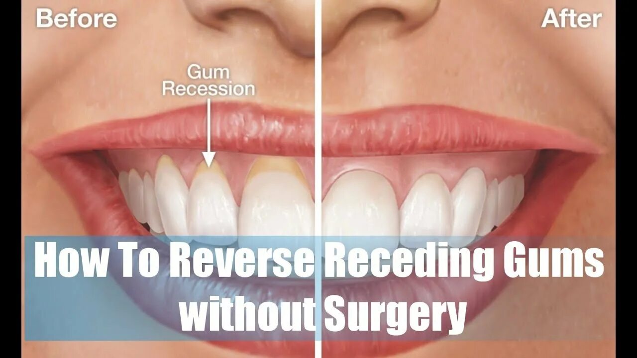 Здоровые зубы. Классификация миллера рецессии десны. Зубы поднимаются вверх. Зубы поднимаются вверх. Пластика рецессии десны.