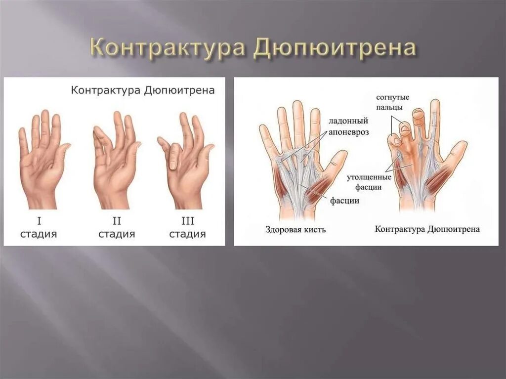 Ладонный фиброматоз (контрактура Дюпюитрена). Сгибательная контрактура кисти. Апоневрэктомия контрактура Дюпюитрена. Контрактура Дюпюитрена правой кисти. Контрактура сустава код по мкб 10