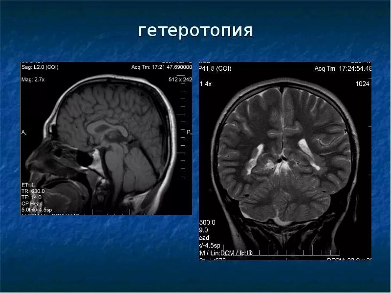 Узловая гетеротопия. Гетеротопия серого вещества мрт. Узловая гетеротопия. Перивентрикулярная гетеротопия мрт. Перивентрикулярная гетеротопия мрт.