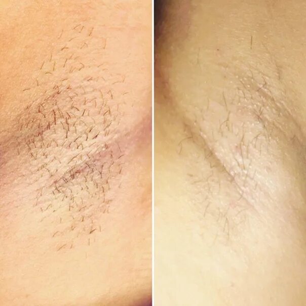 Баня после шугаринга. Подмышки до и после шугаринга. Шугаринг бикини. Баня после шугаринга. Эпиляция бикини глубокое.