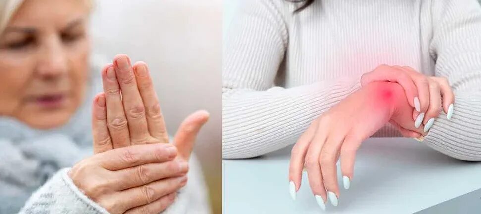 Эффективное лечение артрита. Болят суставы кистей рук. Ревматоидный артрит кистей рук. Лекарство при во паллении суставов кистей рук.