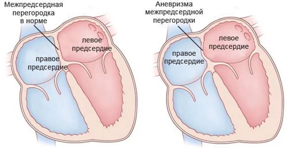 Дефект мпп. Межпредсердная перегородка аневризма. дефект межпредсердной перегородки сердца. дефект предсердной перегородки.