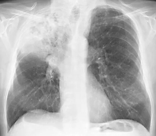 Крупозная пневмония рентген снимок. Крупозная пневмония легкого рентгенограмма. Рентгенография крупозной пневмонии. Крупозная пневмония легкого рентген.