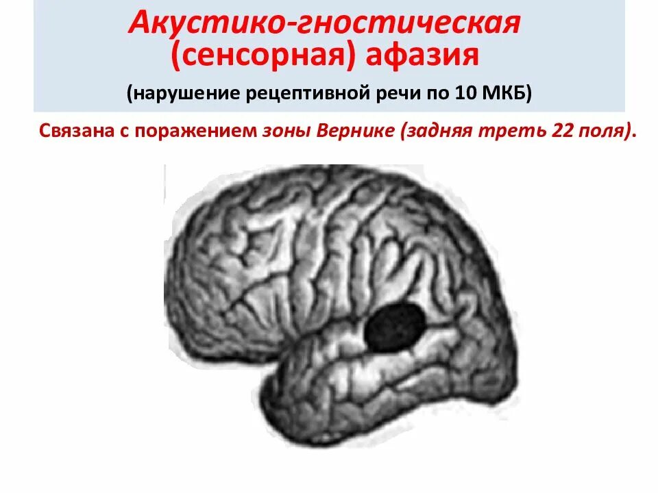 Акустико семантической афазии. Акустико-гностическая сенсорная афазия локализация. сенсорная афазия зона поражения. акустико-гностическая афазия симптоматика. сенсорная афазия очаг поражения.