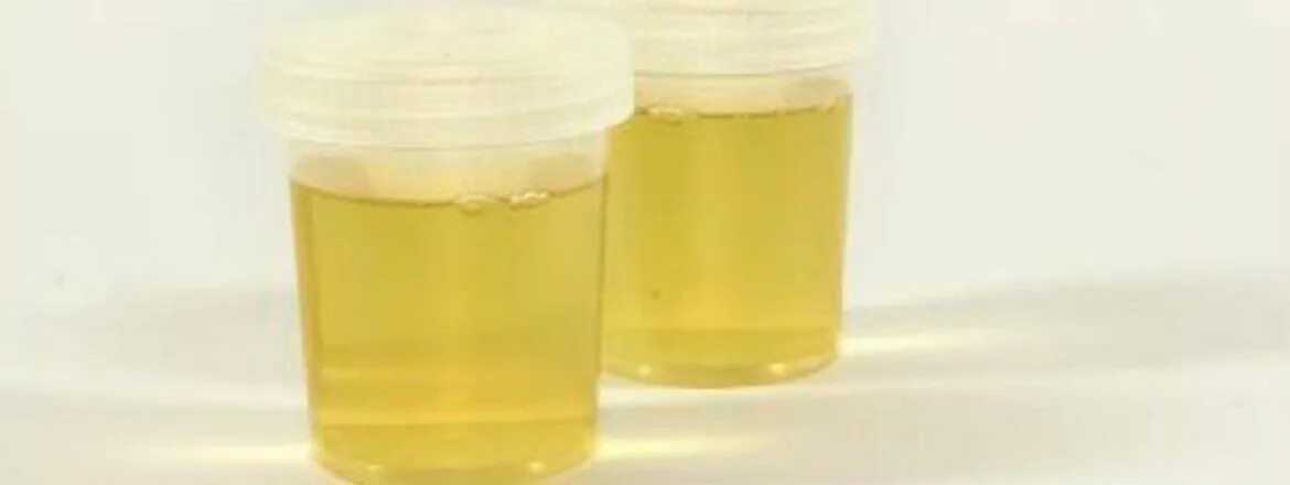 почечный эпителий. осадки в моче у женщин причины. осадок в моче. слизь в моче. хлопья в моче.