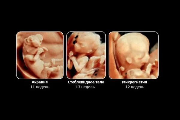 Во сколько недель делают первое. Скрининг при беременности. скринги во сколько недель.