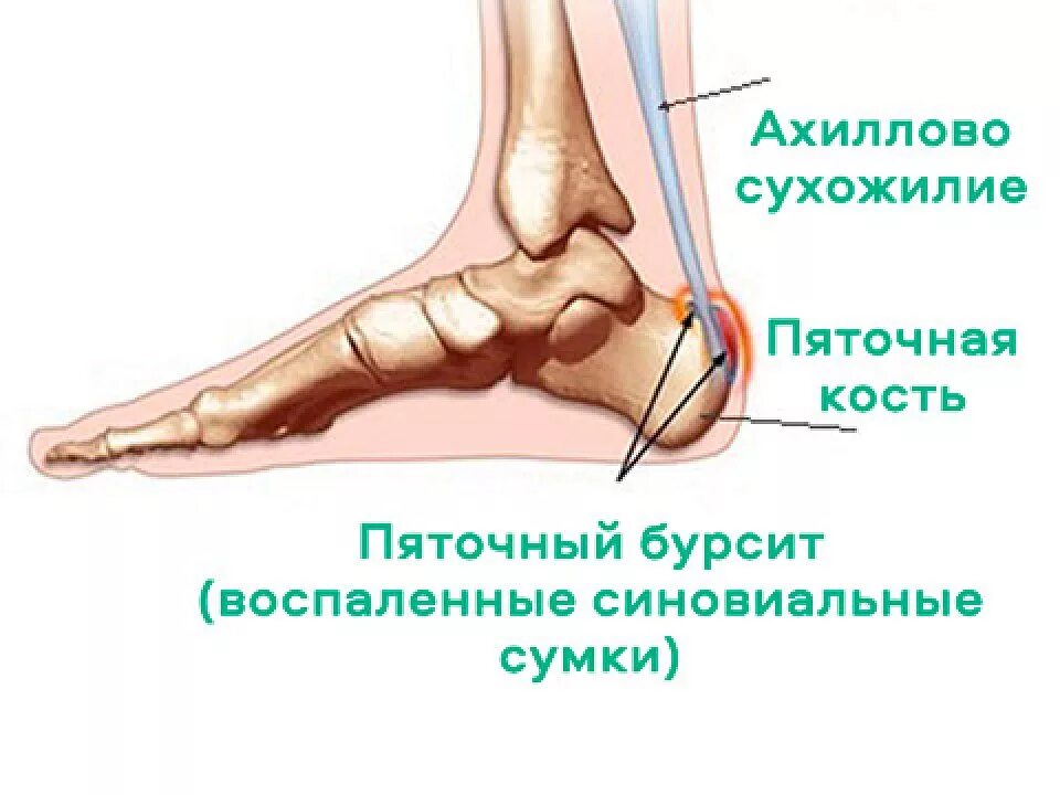 Бурсит голеностопа лечение. Подкожная пяточная синовиальная сумки бурсит. Бурсит голеностопного сухожилия. Бурсит голеностопа лечение. Бурсит голеностопа лечение.