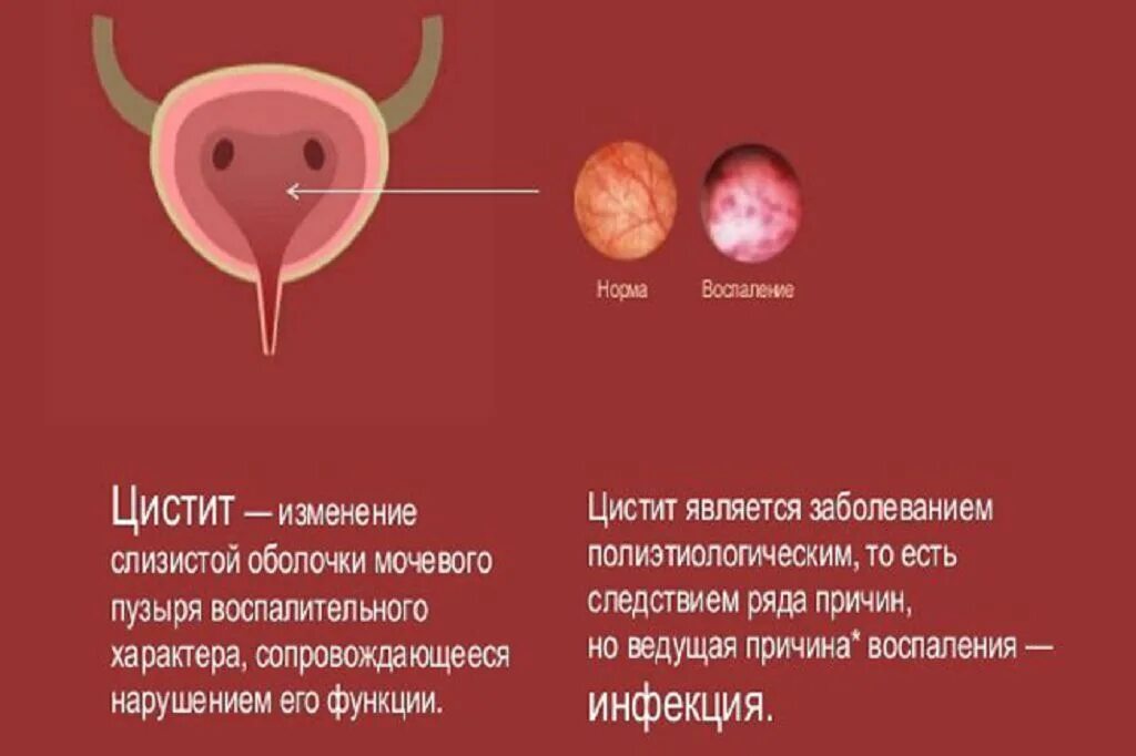 Болезнь мочевого пузыря у женщин лечение. Воспаление мочевого пузыря симптомы.