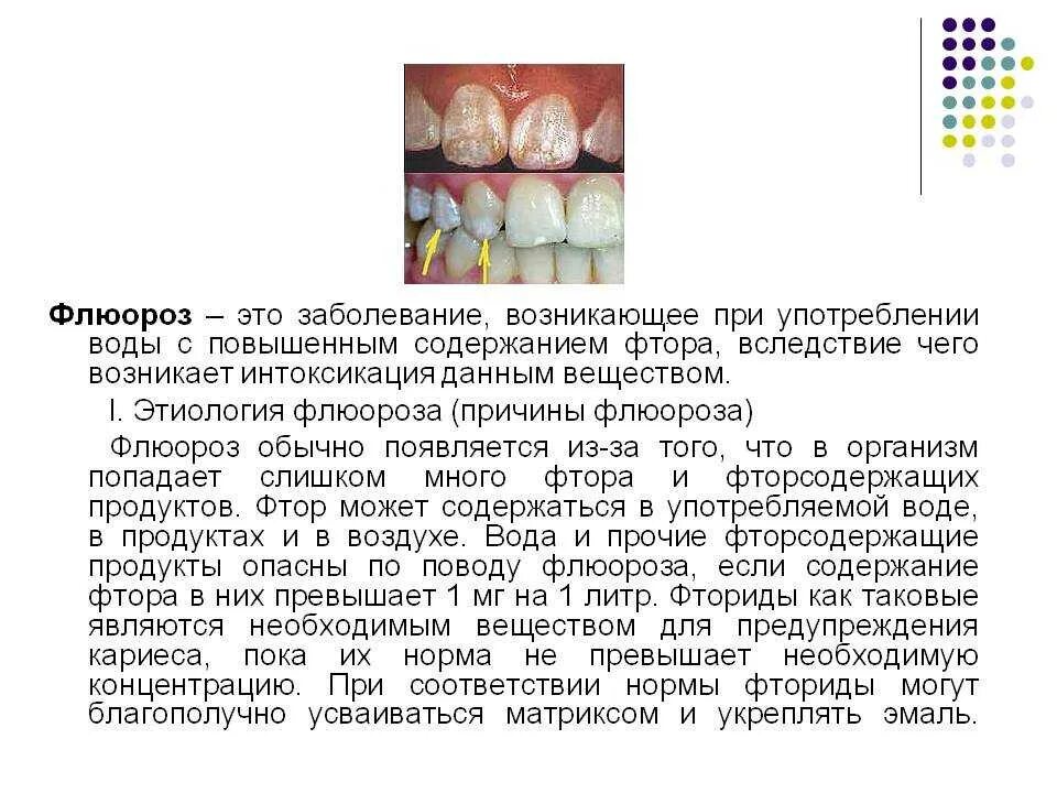 Меловидно крапчатый флюороз. Флюороз механизм развития. Этиология флюороза. Этиология флюороза. Патогенез гипоплазии зуба.