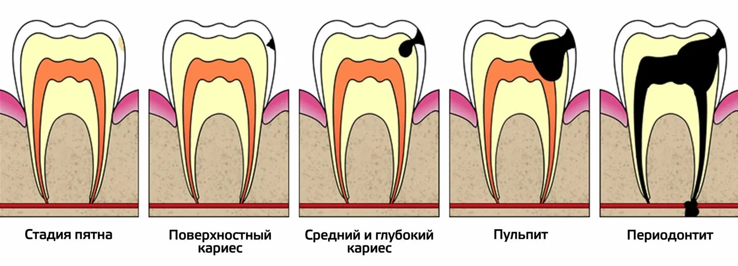 При каком кариесе удаляют зуб