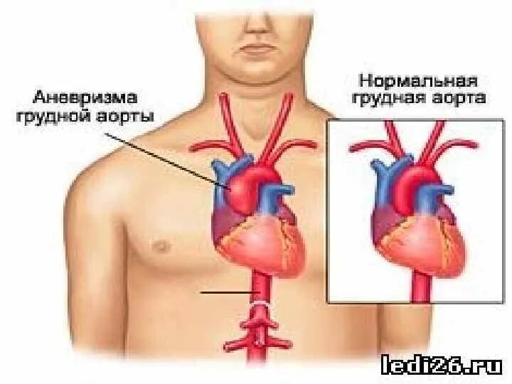 Аневризма сердца что это такое симптомы. Синдром Марфана аневризма аорты. Аневризма аорты сердца. Расширение грудной аорты. Разрыв аневризмы грудной аорты.