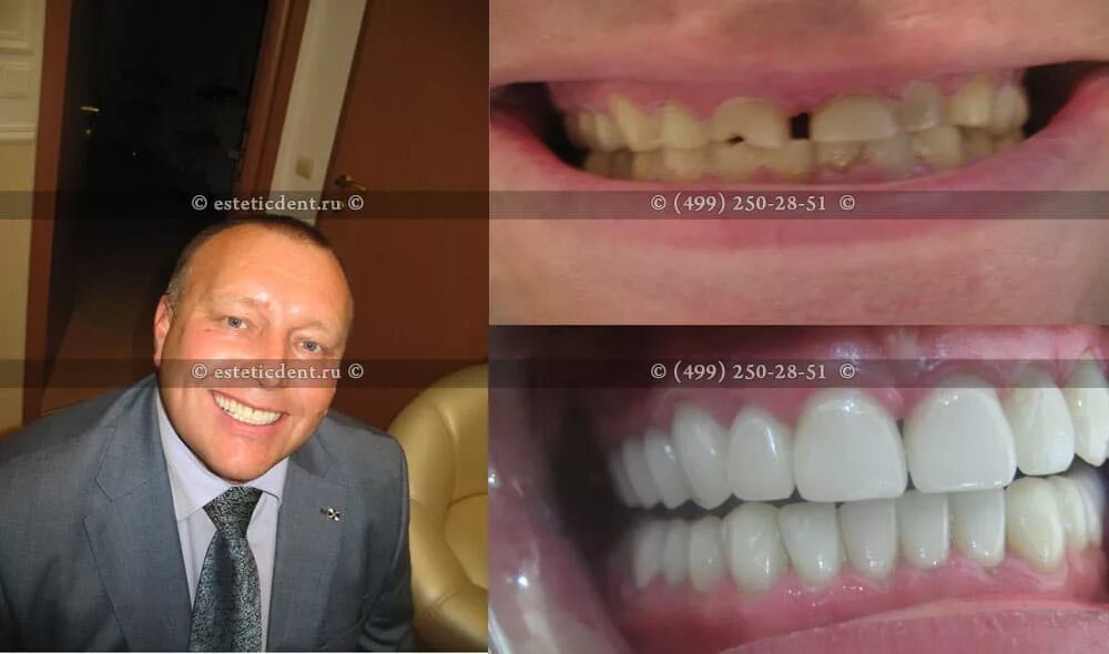 Поменять зубы полностью. Имплантант на переднем зубе. Имплантаты в стоматологии. Красивые передние зубы. Зубы до и после имплантации.