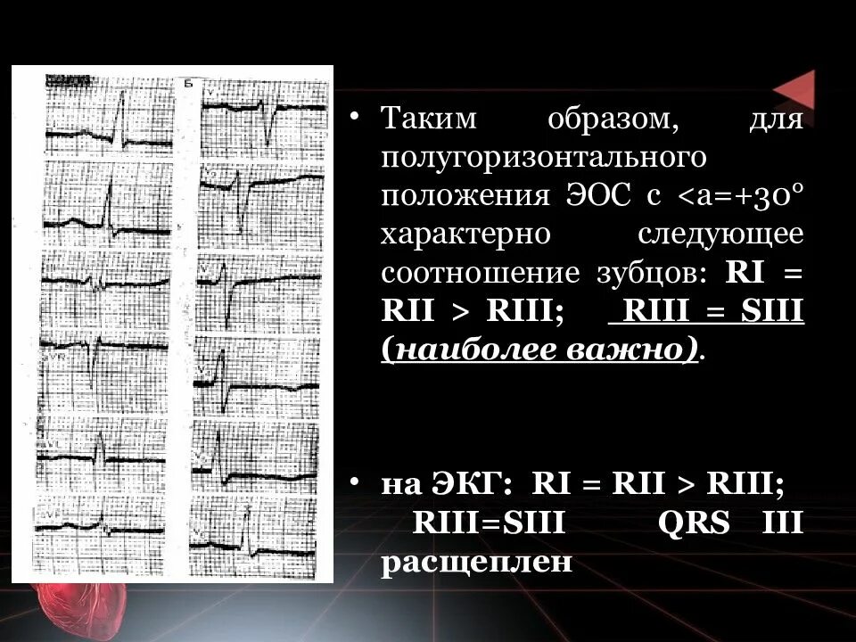 Положение эос у детей. Позиция сердца полугоризонтальная на экг. полугоризонтальное положение эос на экг. электрическая ось экг полугоризонтальная. полугоризонтальное положение эос что это.