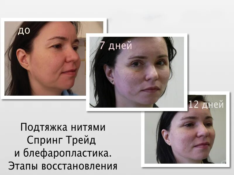 Отек после лифтинга. Реабилитация после нитей. реабилитация после установки нитей. нитевой лифтинг лица реабилитация. отеки после нитевого лифтинга.