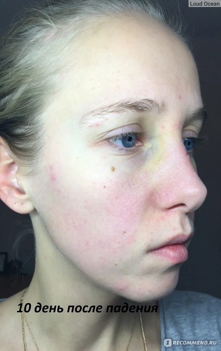 убирание синяков под глазами. чем быстро убрать синяк. мазь от синяков на лице под глазом. как быстро избавиться от синяка под глазом. как вывести синяк на лице.