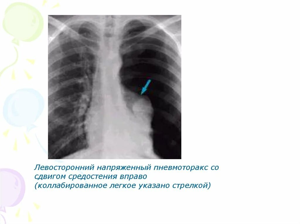 Коллабированное легкое при пневмотораксе. Пневмоторакс коллабирование легкого. коллабированное легкое. коллабированное легкое на рентгене. левосторонний пневмоторакс.