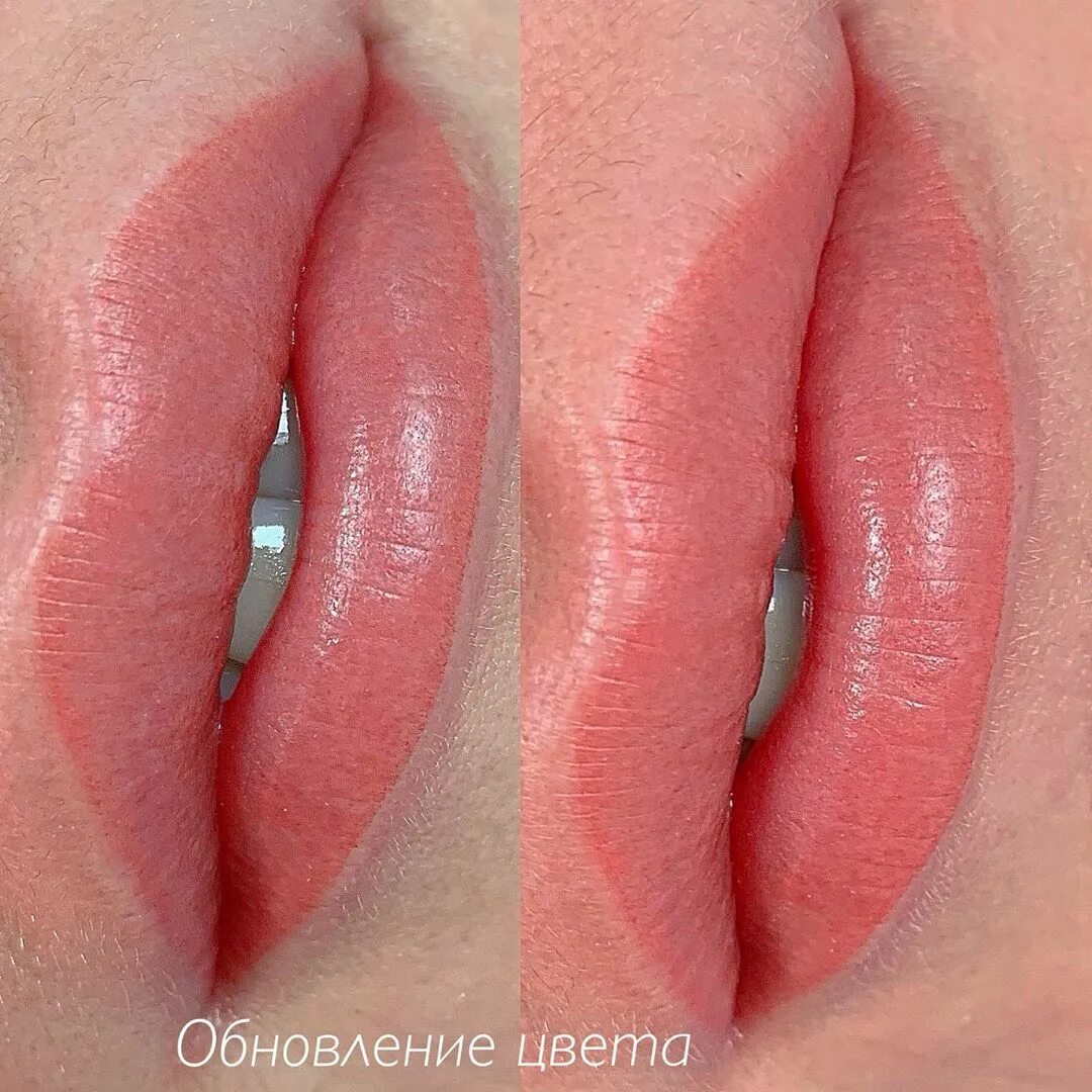 Все о пластике губ по методу Кессельринга