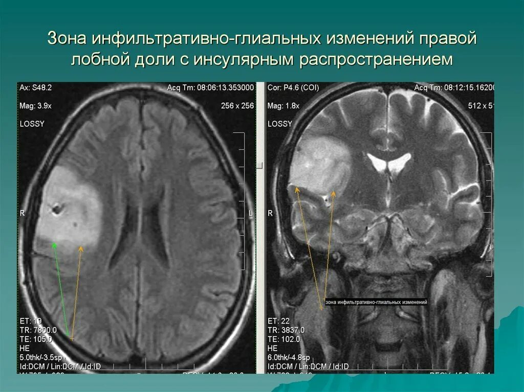 Доли мозга мрт. Поражение лобных долей на мрт. Опухоль правой лобной доли. Инфильтративно глиальные изменения.