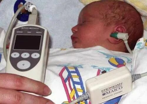Прибор отоакустической эмиссии. Аудиологический скрининг новорожденных. Отоакустическая эмиссия (ОАЭ). Отоакустическая эмиссия у новорожденных. Отоакустическая эмиссия скрининг у новорожденных.